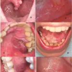 Infections of the Oral Cavity