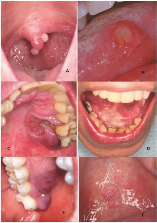 Infections of the Oral Cavity