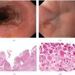 Infectious Esophagitis