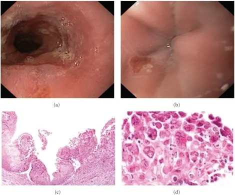 Infectious Esophagitis