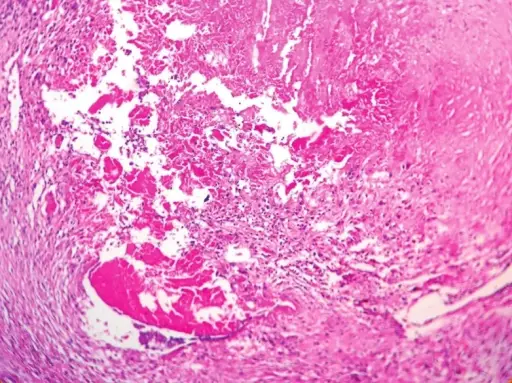 Infective Endocarditis