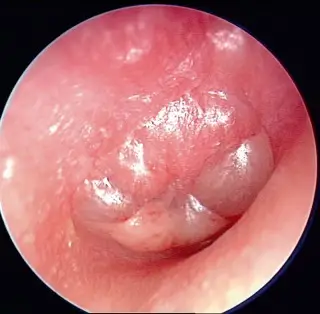 Inflammation of the Ear