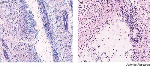 Inflammation of the Larynx