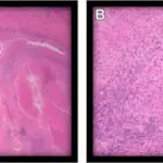 Inflammation of the Prostate