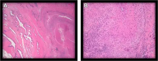 Inflammation of the Prostate