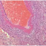 Inflammation of the Testis or Epididymis