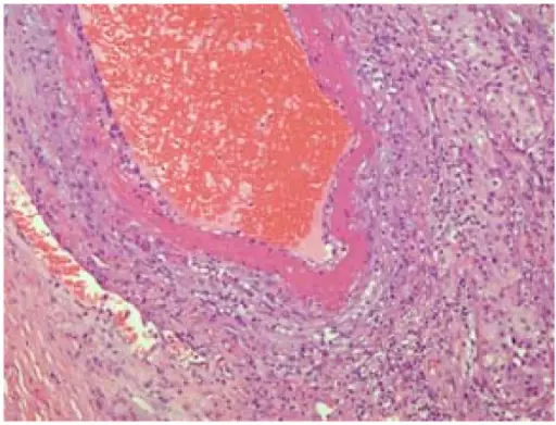 Inflammation of the Testis or Epididymis