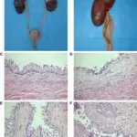 Inflammation of the Ureter