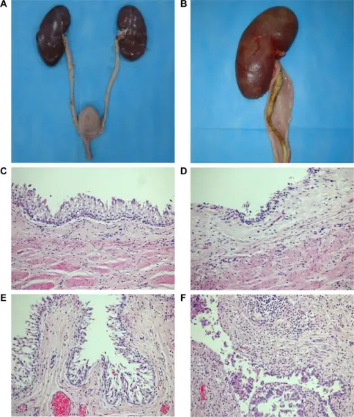 Inflammation of the Ureter