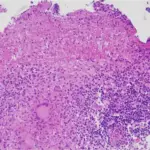 Inflammations of the Nasopharynx