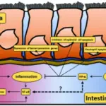 Inflammatory Bowel Disease