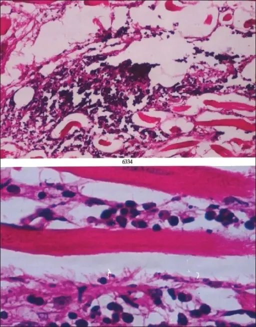 Inflammatory Conditions of the Orbit