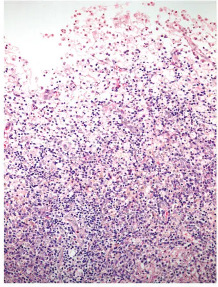 Inflammatory Disorders of the Endometrium