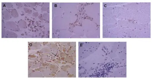 Inflammatory Myopathies