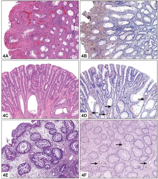 Inflammatory Polyps