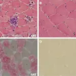 Inherited Disease of Skeletal Muscle