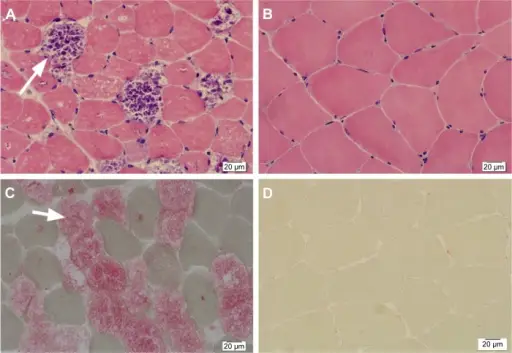 Inherited Disease of Skeletal Muscle