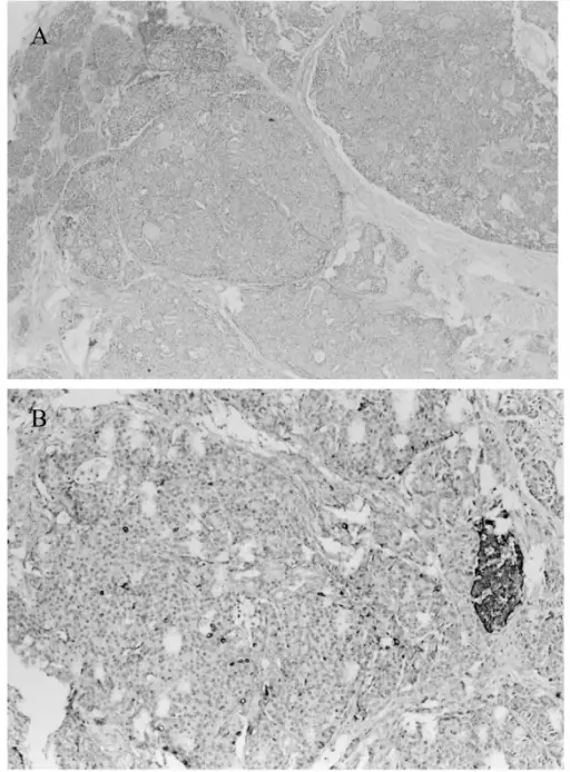 Insulinoma