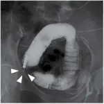 Intestinal Obstruction