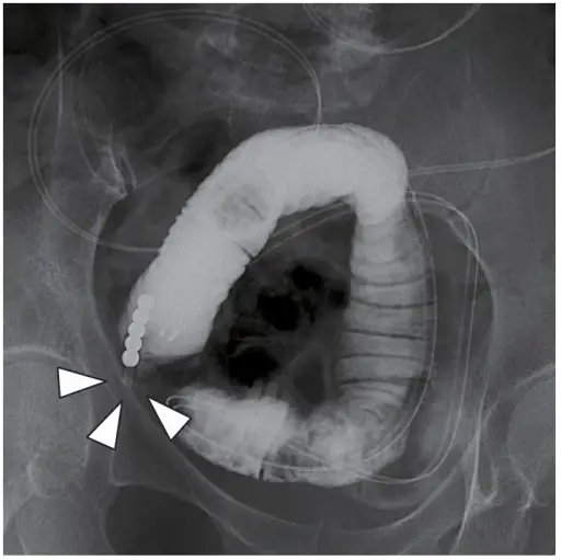 Intestinal Obstruction