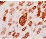 Intraductal Papillary Mucinous Neoplasms (IPMNs)