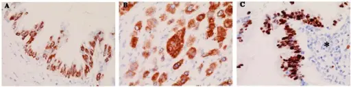 Intraductal Papillary Mucinous Neoplasms (IPMNs)