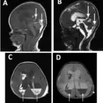 Intraventricular Hemorrhage