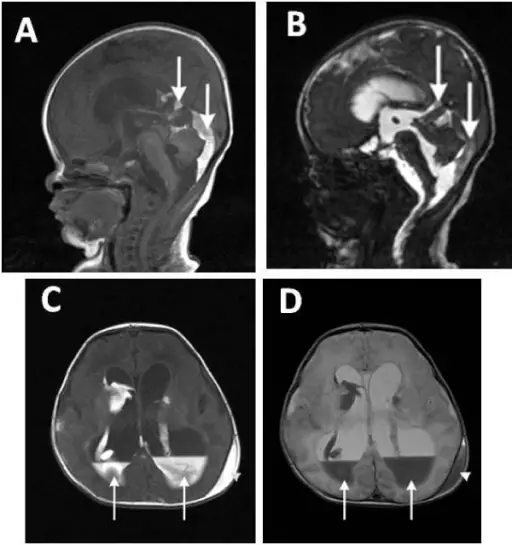 Intraventricular Hemorrhage