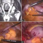 Intussusception