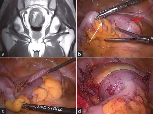 Intussusception