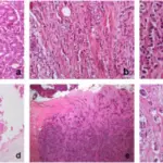 Invasive Papillary Carcinoma