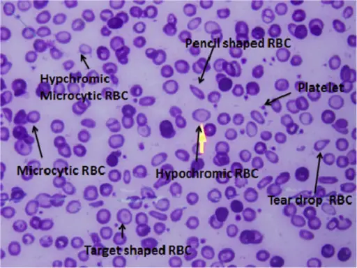 Iron Deficiency Anemia