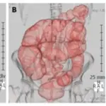 Irritable Bowel Syndrome