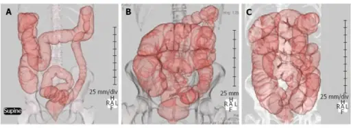 Irritable Bowel Syndrome