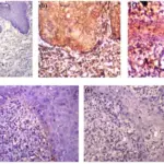 Irritation Fibroma