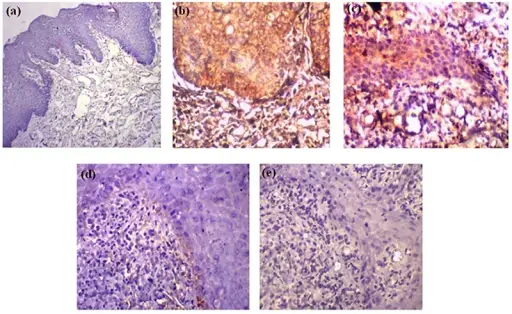 Irritation Fibroma