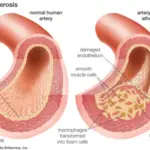 Ischemic Heart Disease