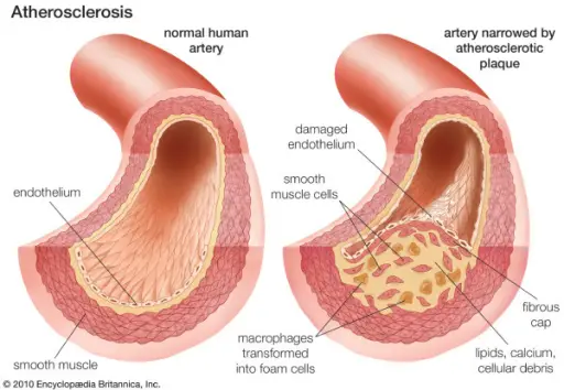 Ischemic Heart Disease