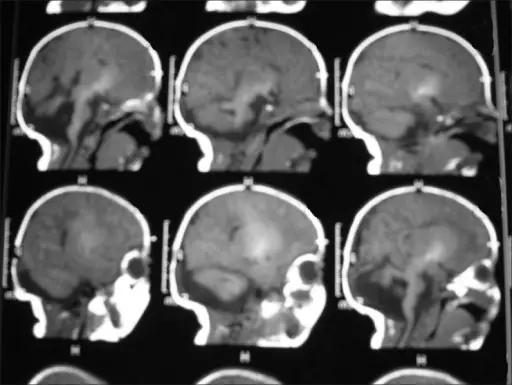 Joubert Syndrome