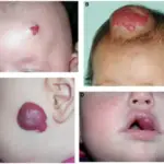 Juvenile Hemangiomas aka Infantile Hemangioma Clinical Picture