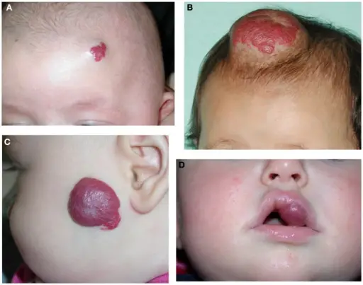 Juvenile Hemangiomas aka Infantile Hemangioma Clinical Picture