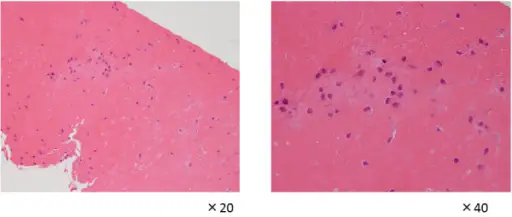 Juvenile Idiopathic Arthritis