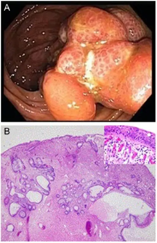 Juvenile Polyps