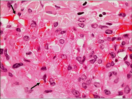 Kaposi Sarcoma