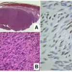 Kaposi Sarcoma HHV8 Stain aka LNA-1