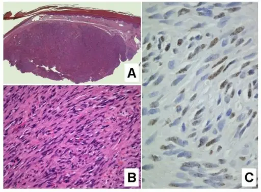 Kaposi Sarcoma HHV8 Stain aka LNA-1