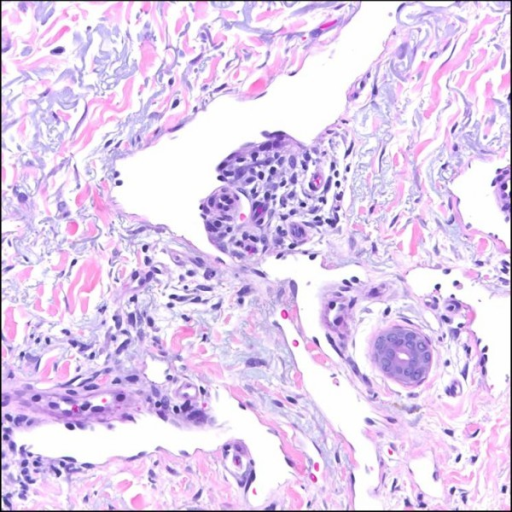 Kaposi Sarcoma Promontory Sign