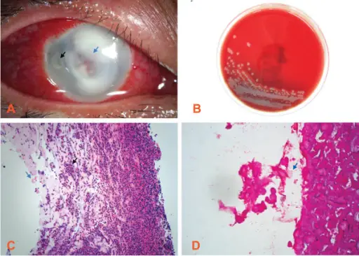 Keratitis