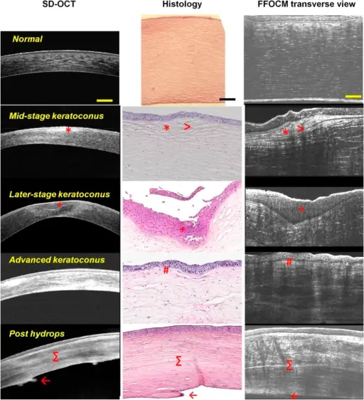 Keratoconcus