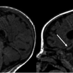 Krabbe Disease